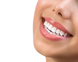 Veneers